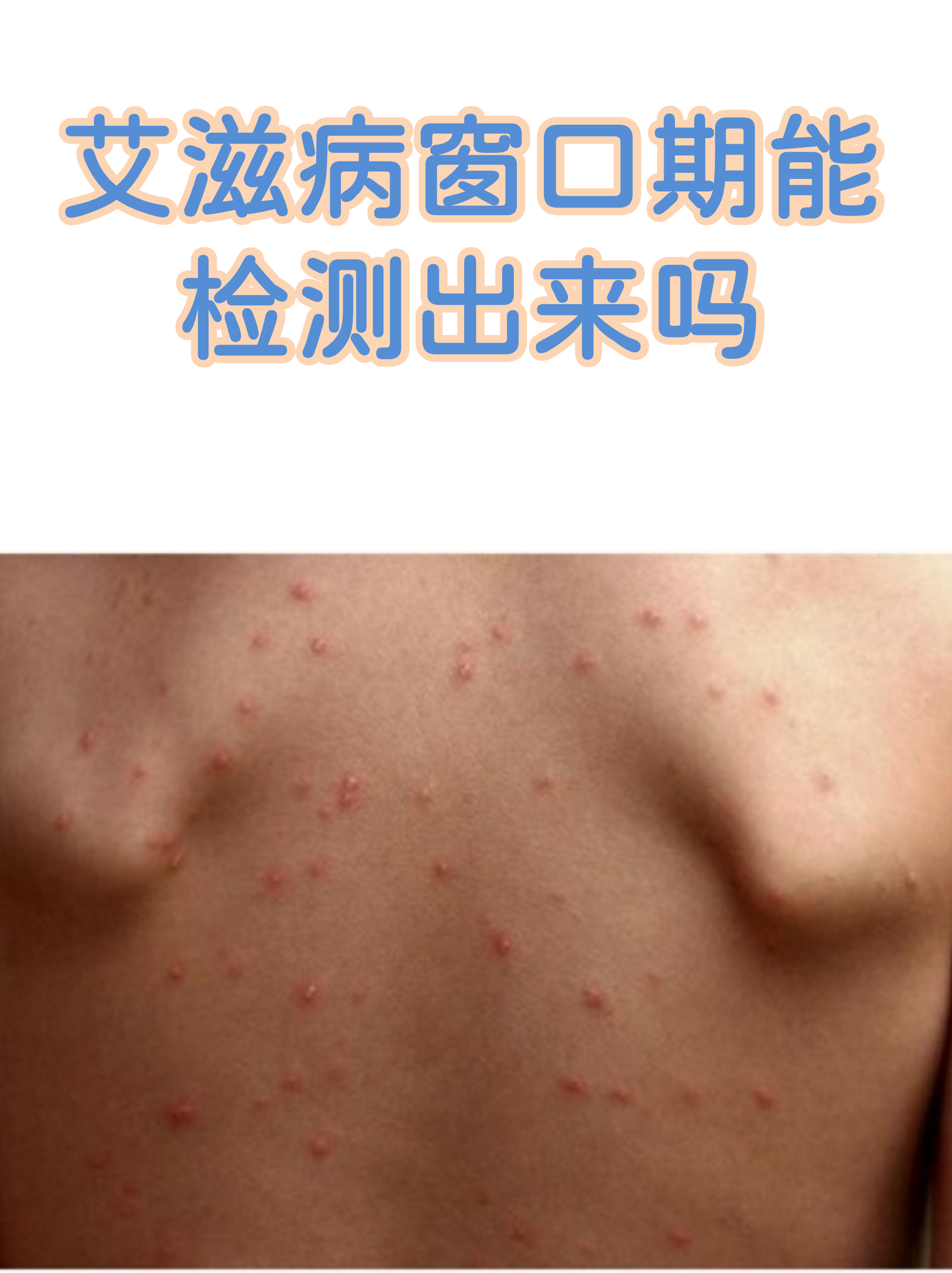 1确诊曾17次核酸阴性〃17次核酸检测阳性-第1张图片